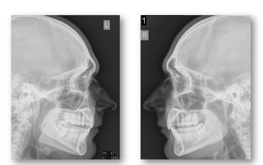 Rhinoplasty MTF Dr. Navin Singh MD